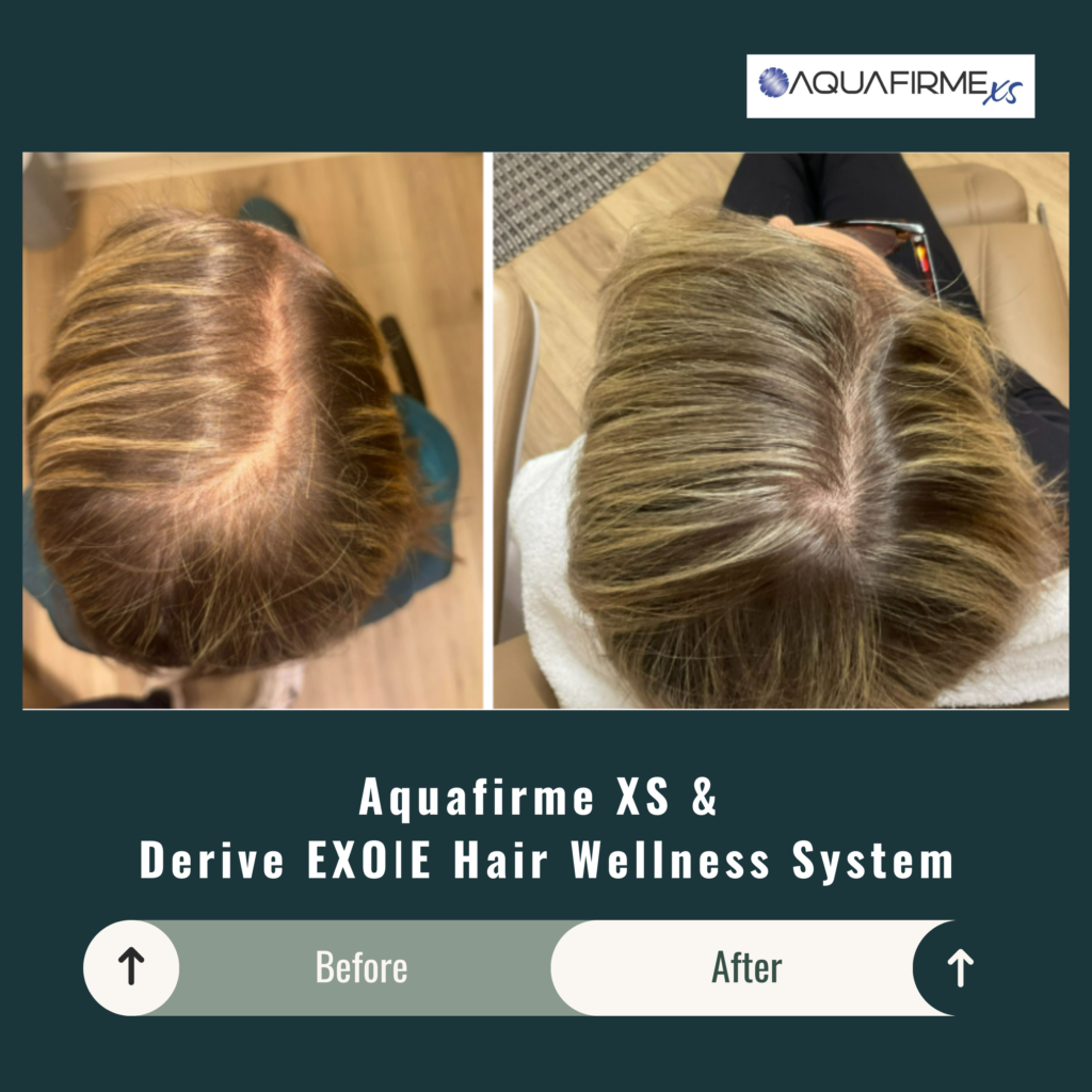 Before and After Image: Aquafirme XS & Derive EXOIE Hair Wellness System - back