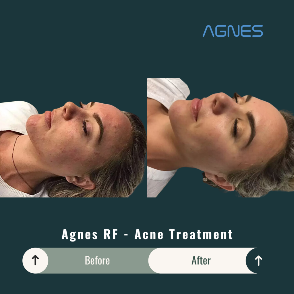 Before and After Image: Agnes RF – Acne Treatment - other