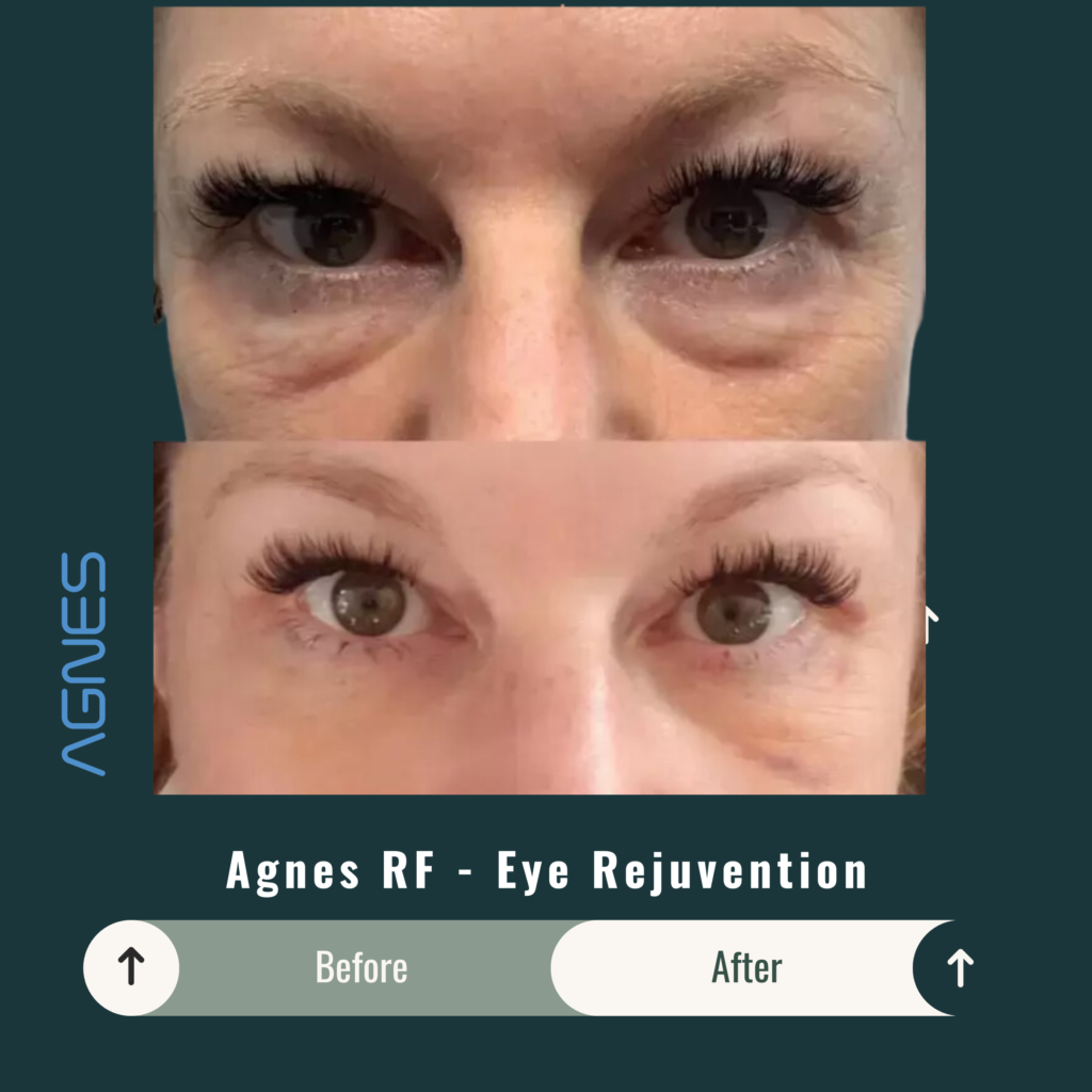 Before and After Image: Agnes RF – Eye Rejuvenation - front