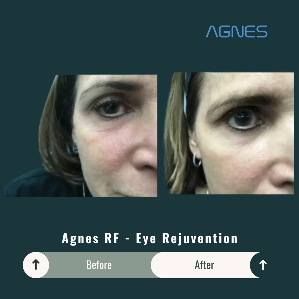 Before and After Image: Agnes RF – Eye Rejuvenation - front