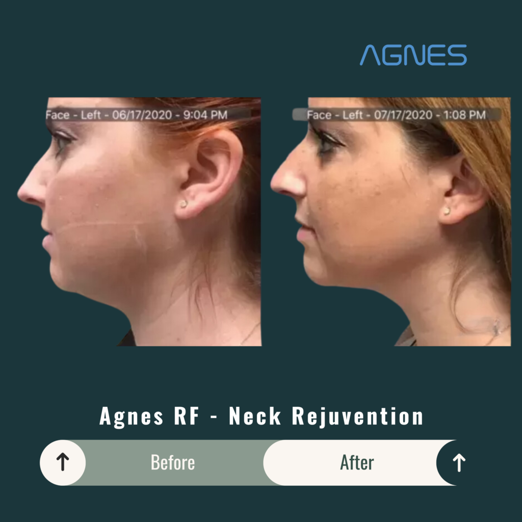 Before and After Image: Agnes RF – Neck Rejuvenation - left-side