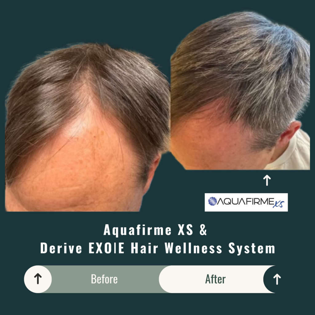 Before and After Image: Aquafirme XS & Derive EXOIE Hair Wellness System - left-front-oblique