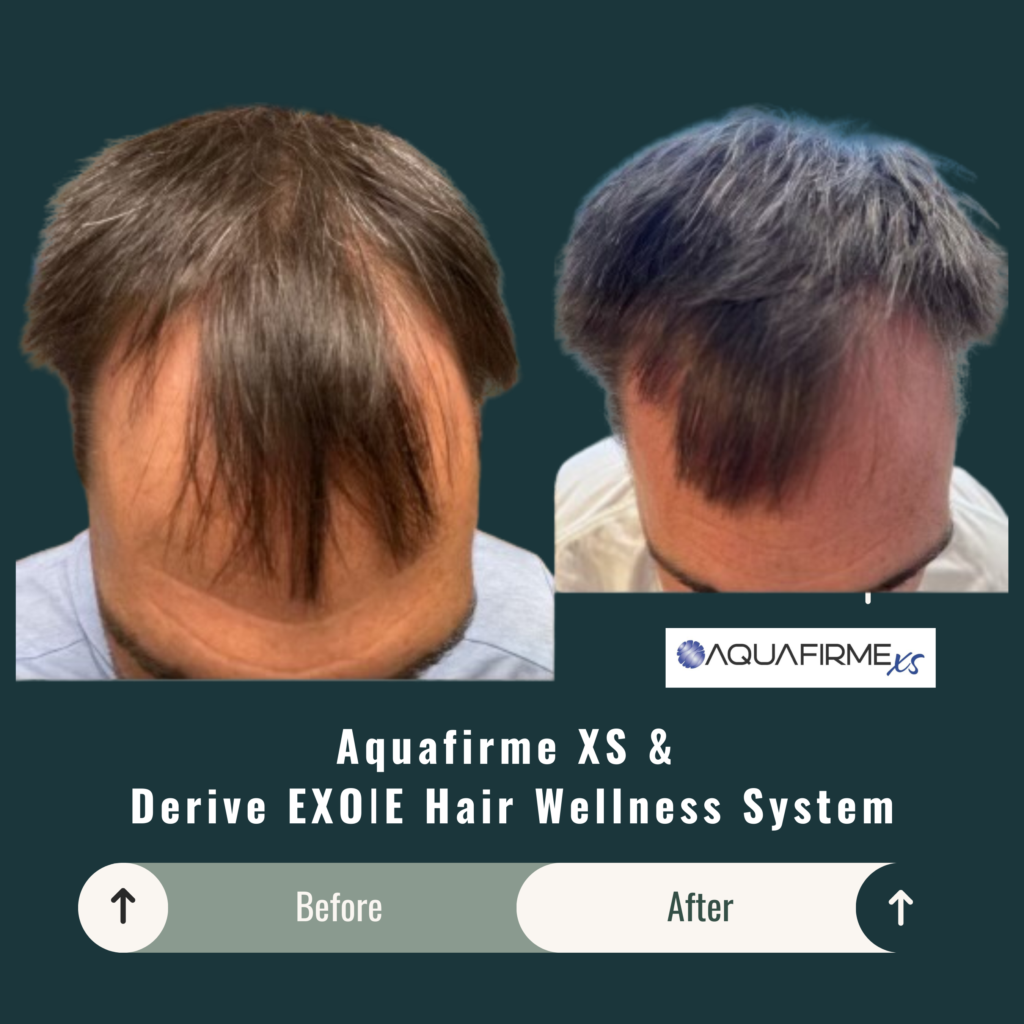 Before and After Image: Aquafirme XS & Derive EXOIE Hair Wellness System - front