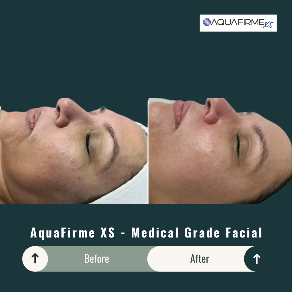 Before and After Image: Aquafirme XS – Medical Grade Facial - other