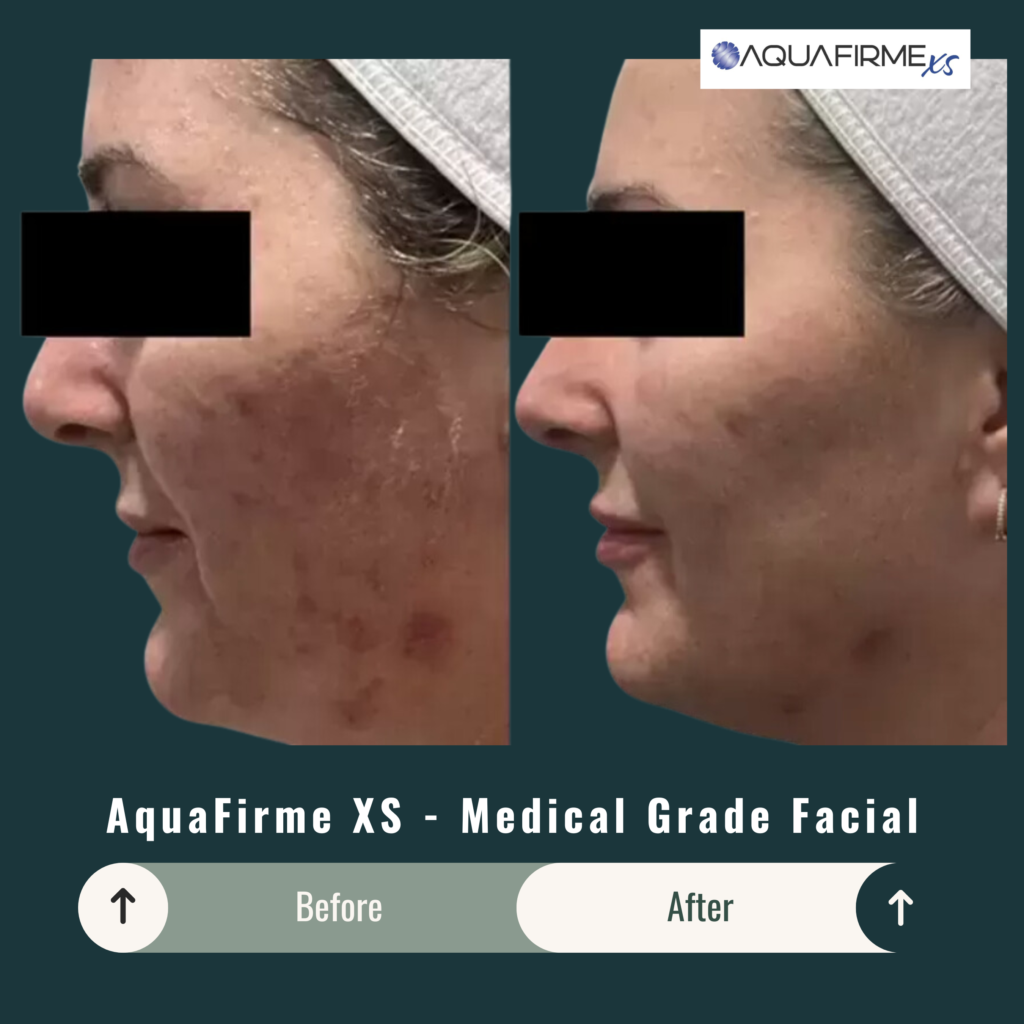 Before and After Image: Aquafirme XS – Medical Grade Facial - left-side