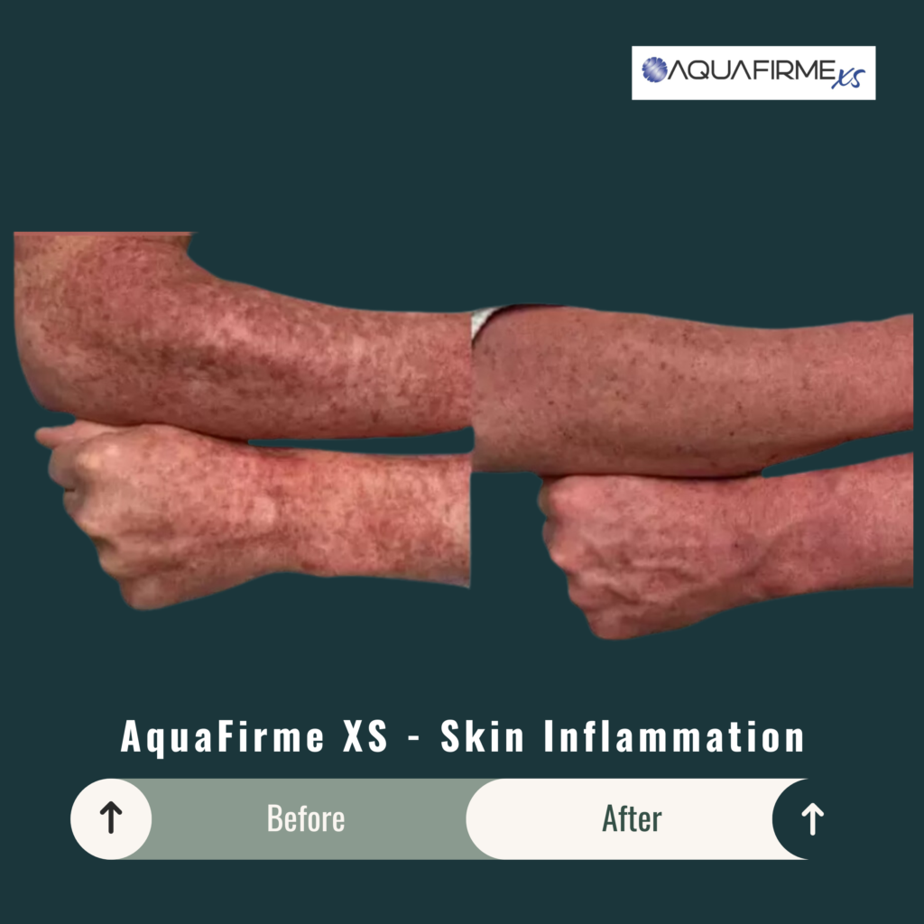 Before and After Image: Aquafirme XS – Skin Inflammation - left-side