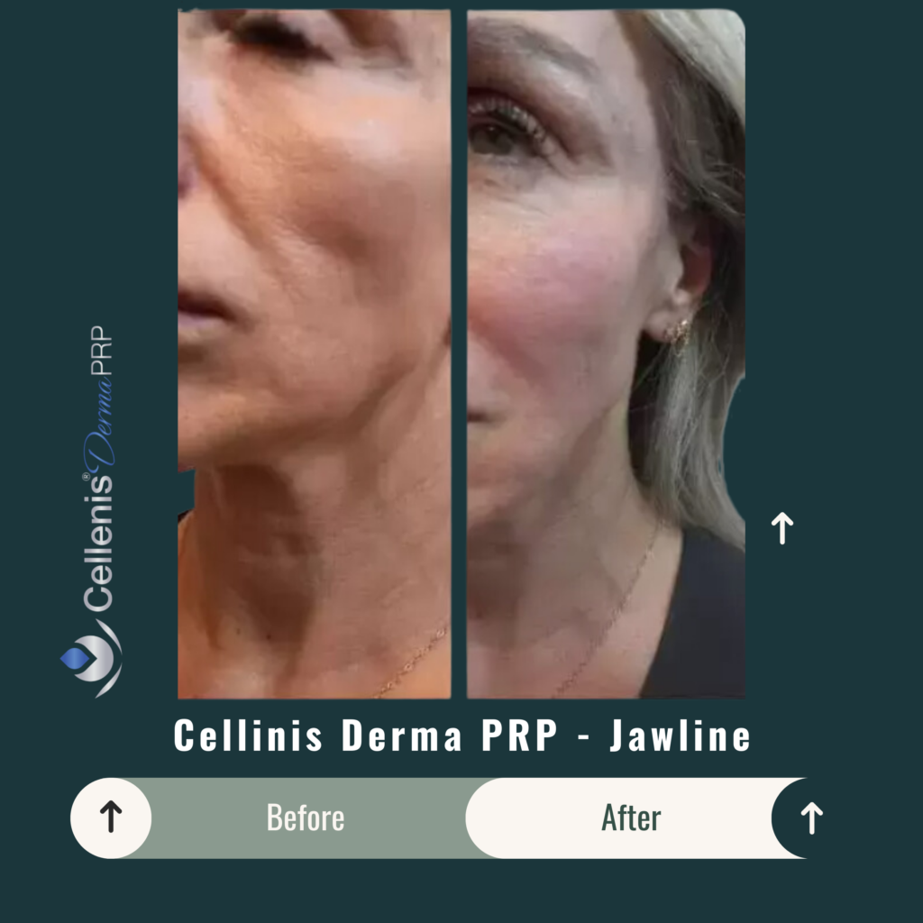Before and After Image: Cellinis Derma PRP – Jawline - left-front-oblique
