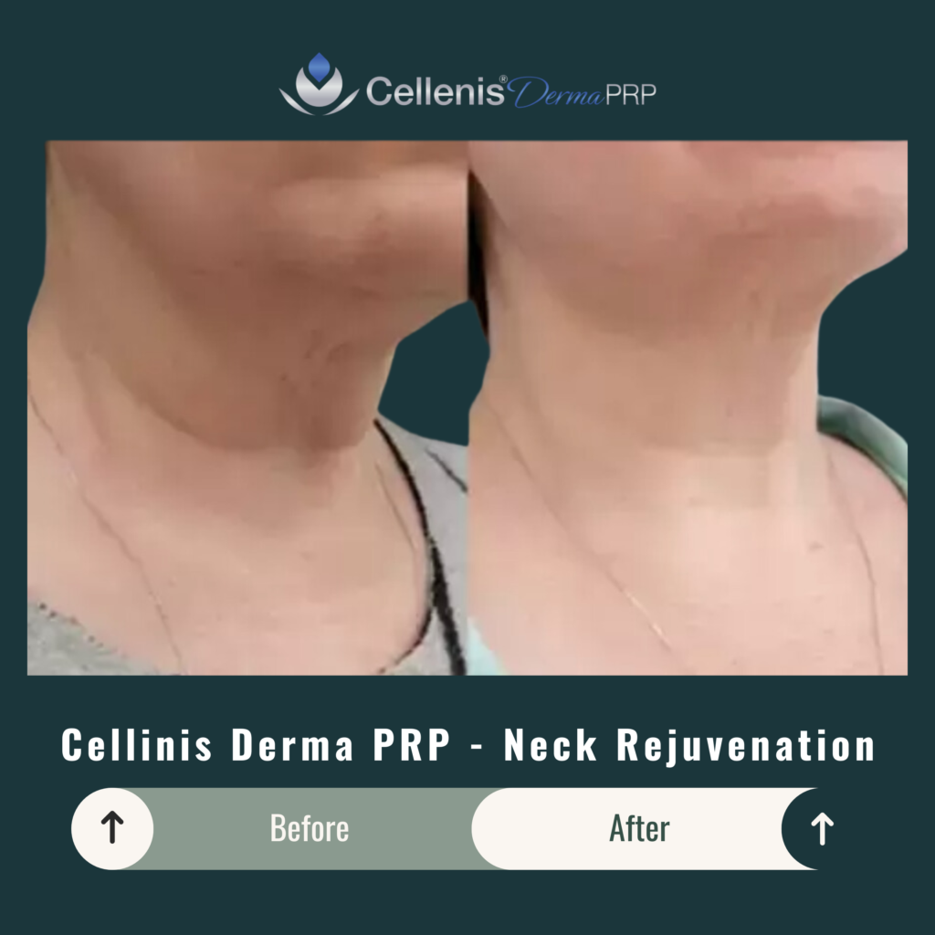 Before and After Image: Cellinis Derma PRP – Neck Rejuvenation - right-front-oblique
