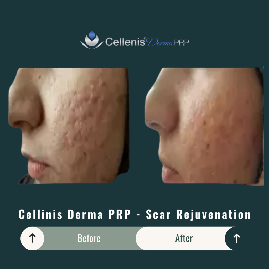 Before and After Image: Cellinis Derma PRP – Scar Rejuvenation - left-side