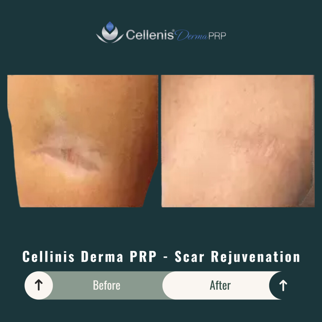 Before and After Image: Cellinis Derma PRP – Scar Rejuvenation - back