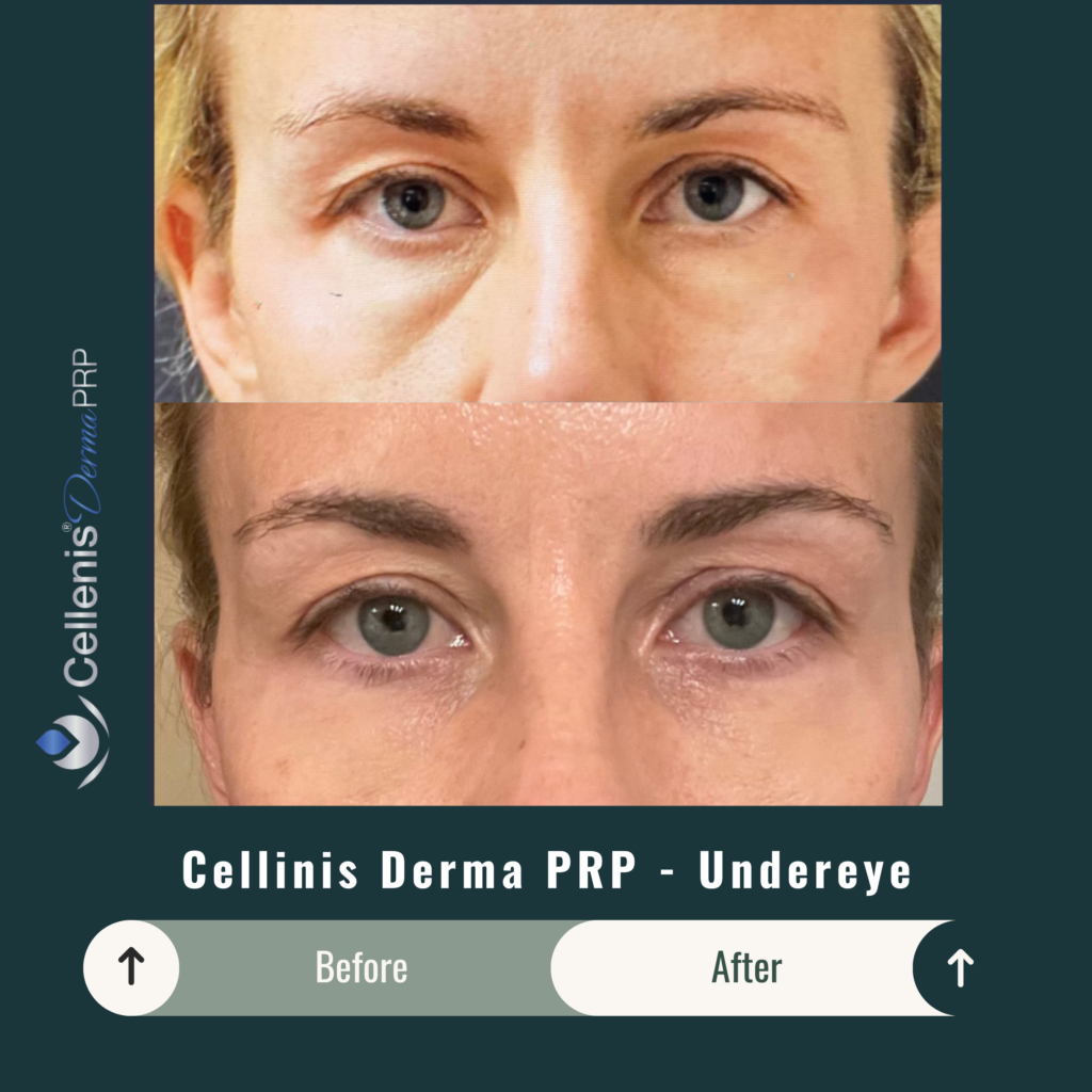 Before and After Image: Cellinis Derma PRP – Undereye - front