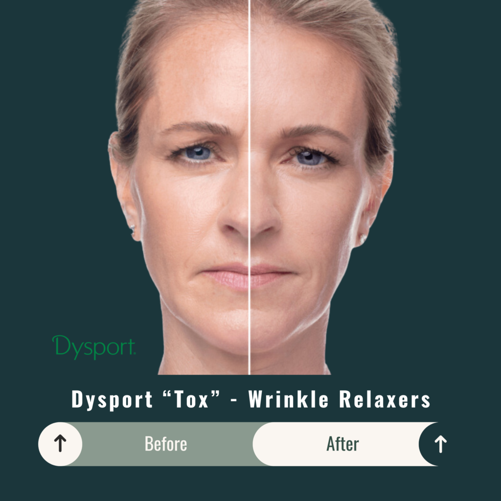 Before and After Image: Dysport “Tox” – Wrinkle Relaxers - front