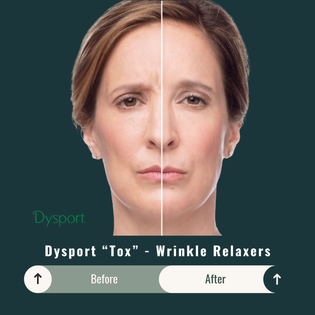 Before and After Image: Dysport “Tox” – Wrinkle Relaxers - front