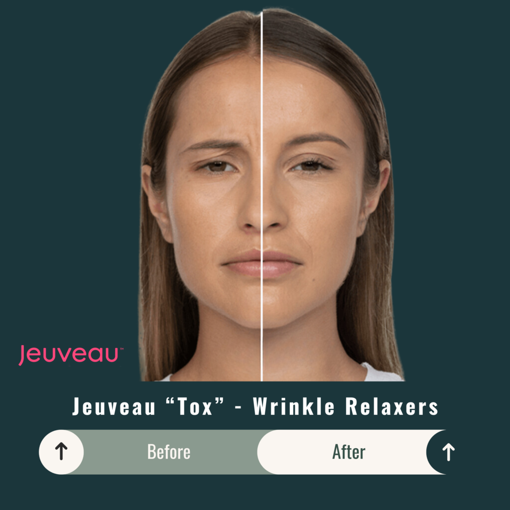 Before and After Image: Jeuveau “Tox” – Wrinkle Relaxers - front