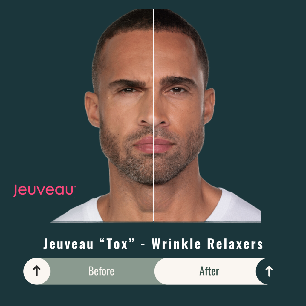 Before and After Image: Jeuveau “Tox” – Wrinkle Relaxers - front