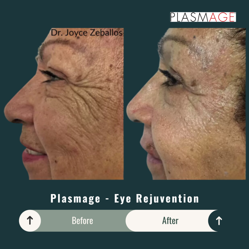 Before and After Image: Plasmage – Eye Rejuvenation - left-side