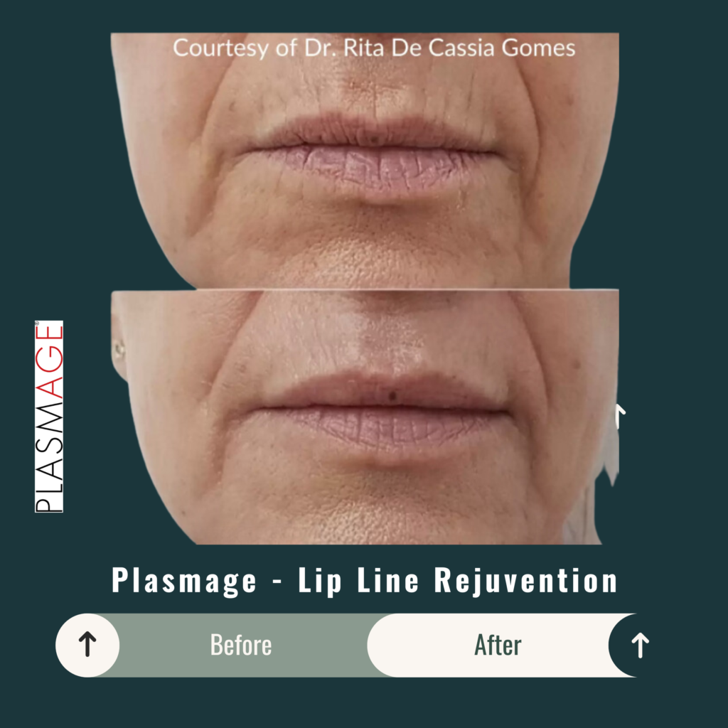 Before and After Image: Plasmage – Lip Line Rejuvenation - front