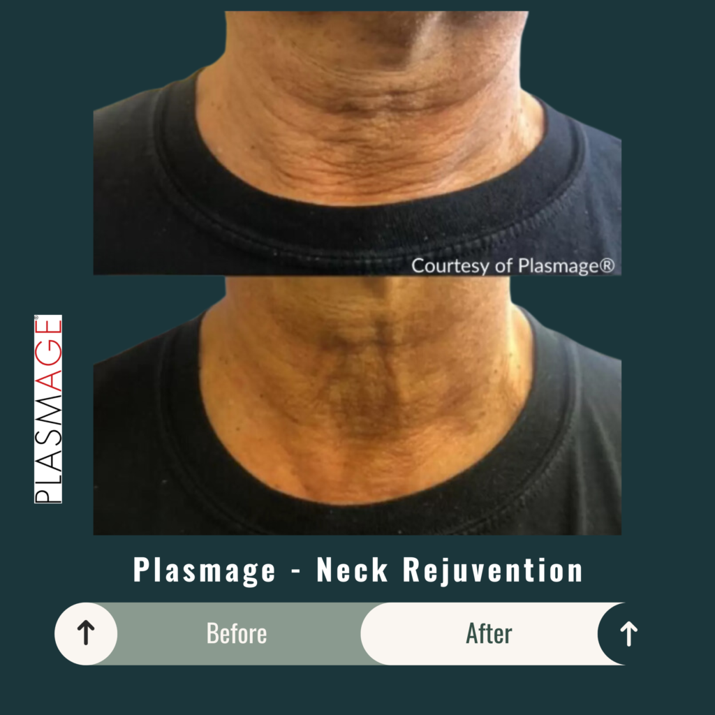 Before and After Image: Plasmage – Neck Rejuvenation - front