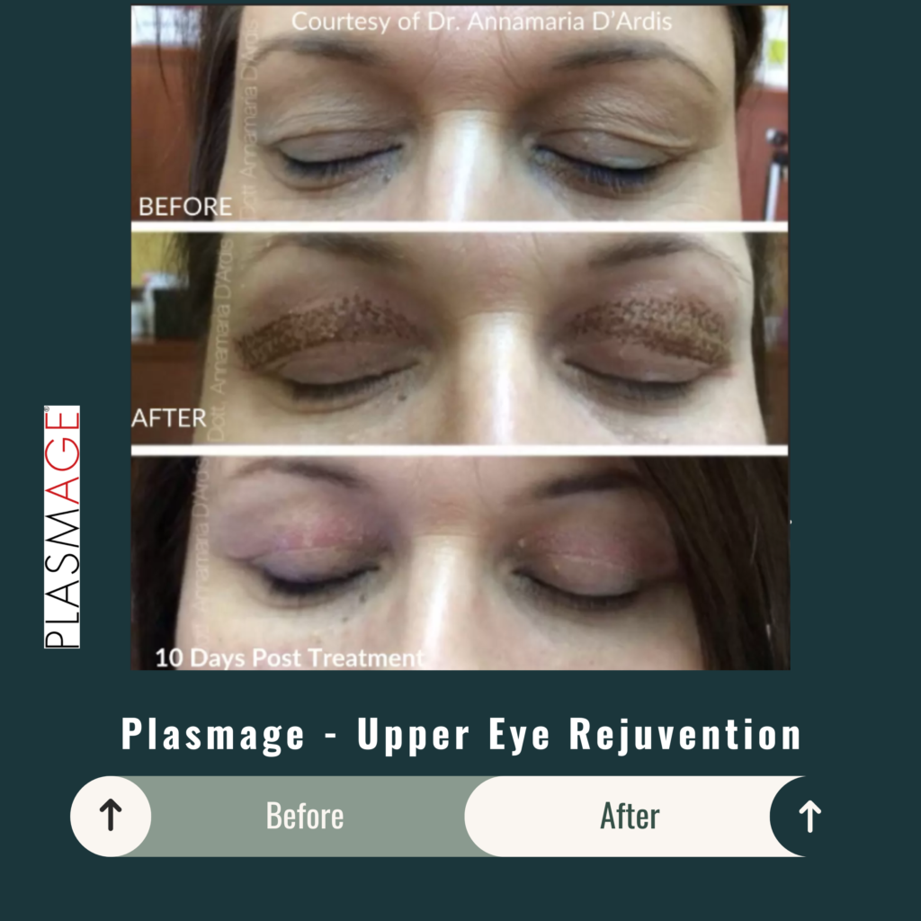Before and After Image: Plasmage – Upper Eye Rejuvenation - front