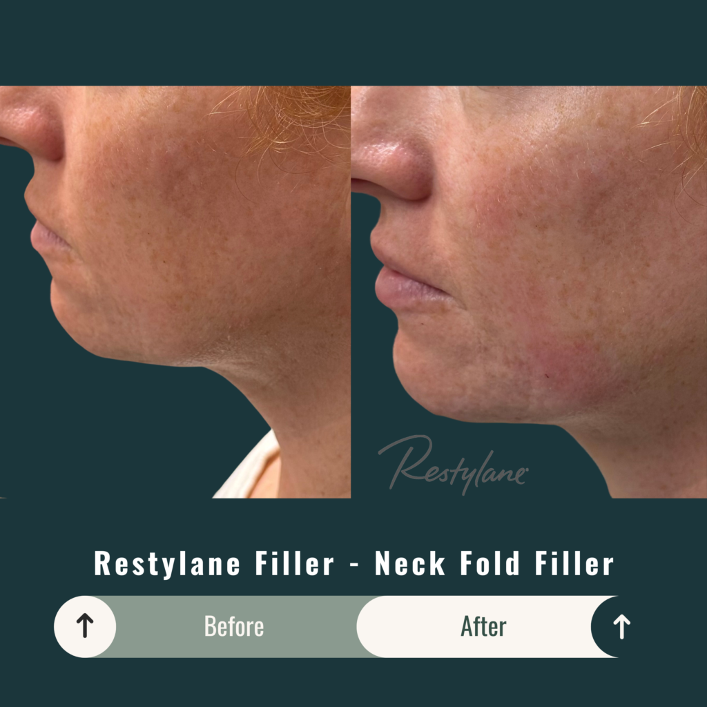 Before and After Image: Restylane Filler – Neck Fold Filler - left-side