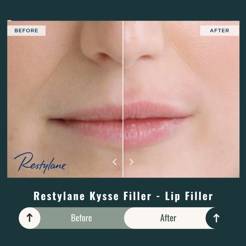 Before and After Image: Restylane Kysse Filler – Lip Filler - front