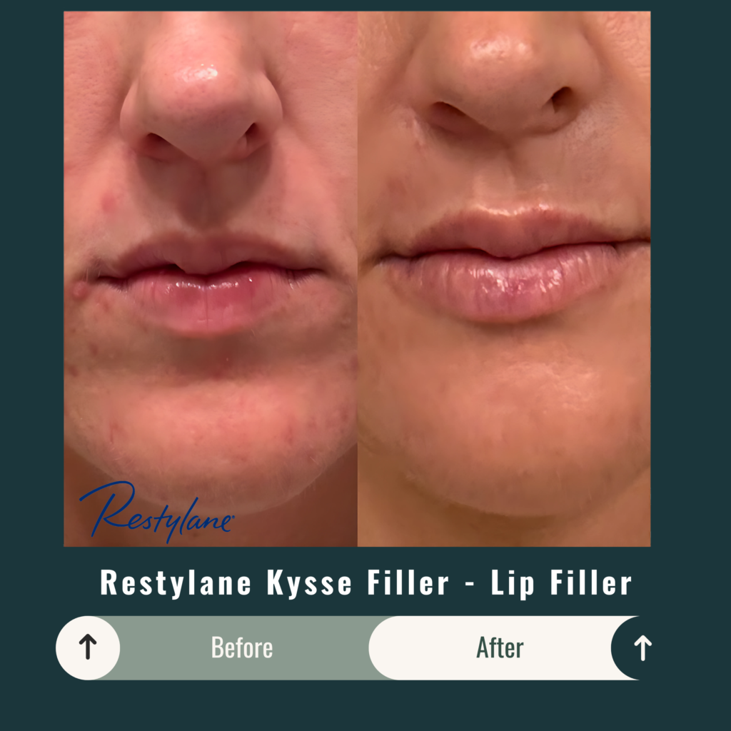 Before and After Image: Restylane Kysse Filler – Lip Filler - front