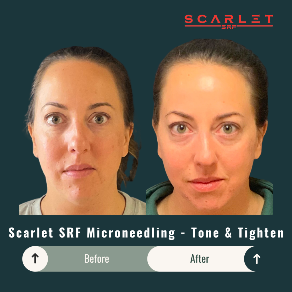 Before and After Image: Scarlet SRF Microneedling – Tone & Tighten - front