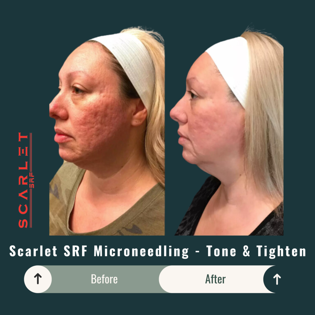 Before and After Image: Scarlet SRF Microneedling – Tone & Tighten - left-front-oblique