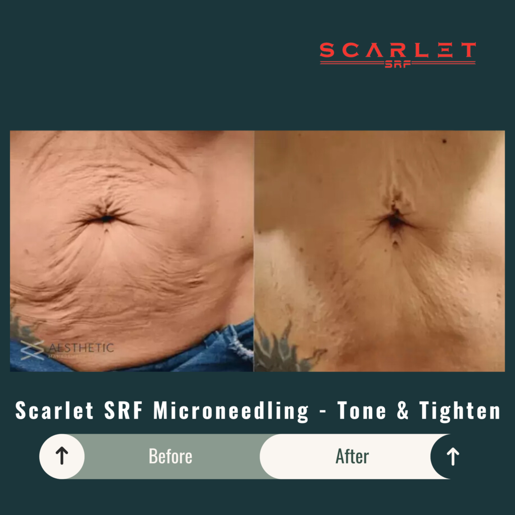 Before and After Image: Scarlet SRF Microneedling – Tone & Tighten - front