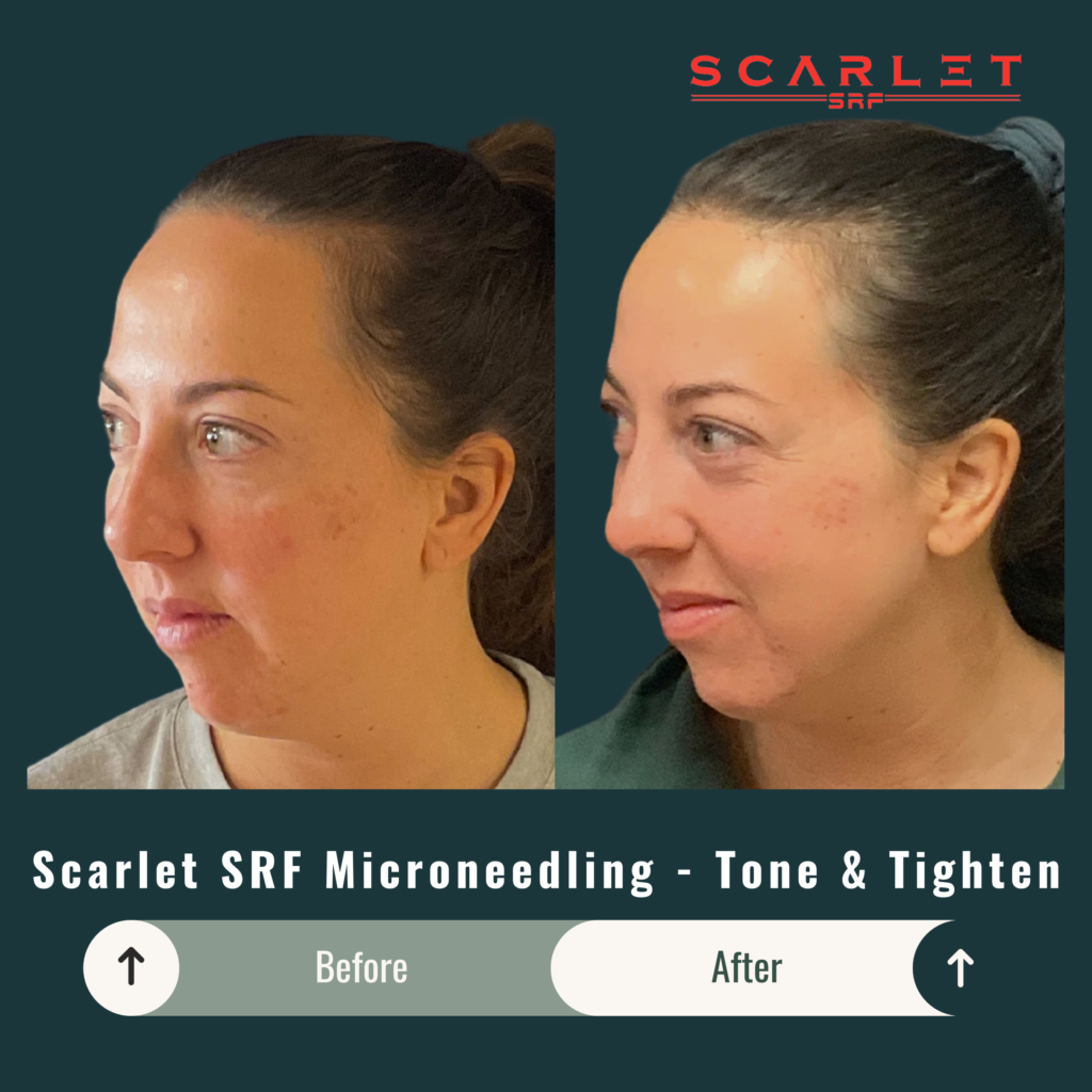 Before and After Image: Scarlet SRF Microneedling – Tone & Tighten - left-front-oblique