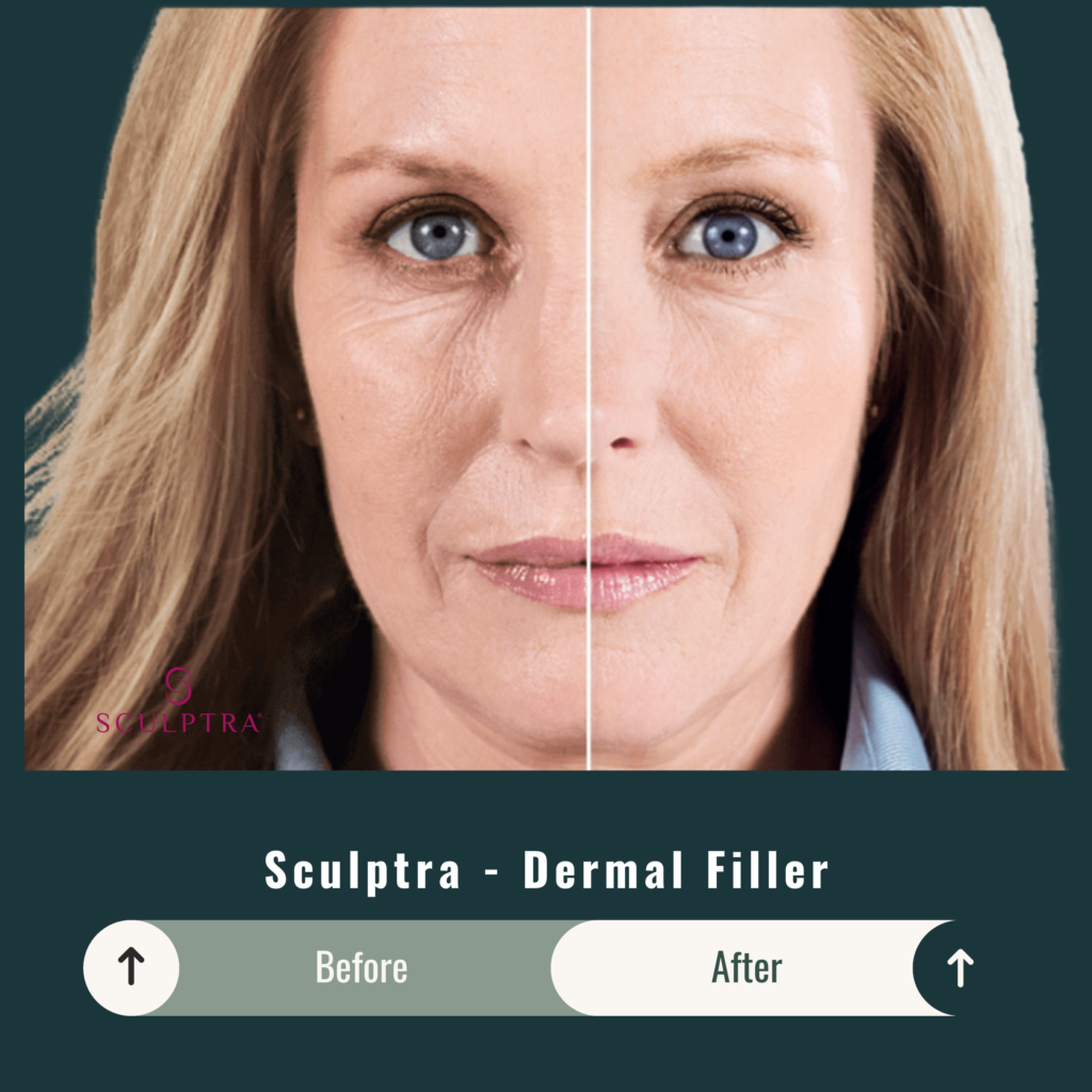 Before and After Image: Sculptra – Dermal Filler - front