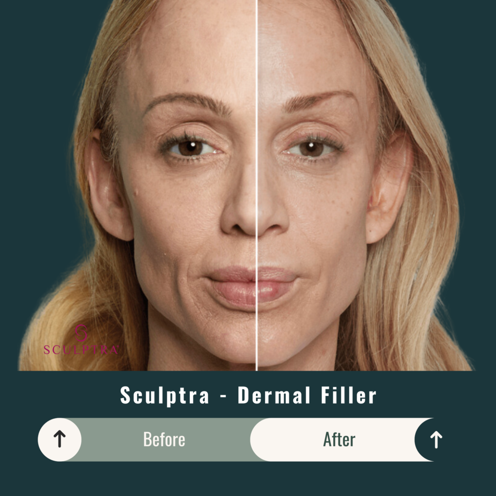 Before and After Image: Sculptra – Dermal Filler - front