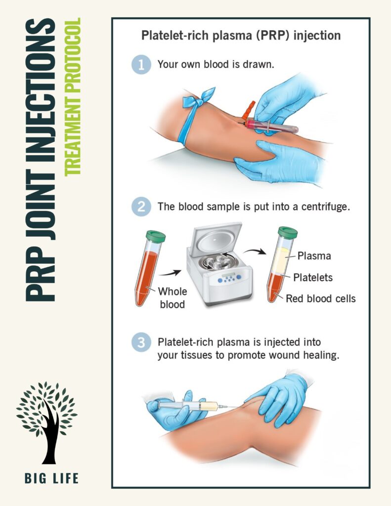 Joint Injections in Lone Tree, CO 3 prp how to